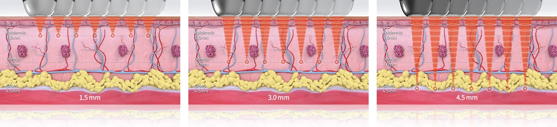 1.5mm, 3.0mm, 4.5mm 깊이에 열 응고점이 생기는 제조사 공식 단면 그림 세 장