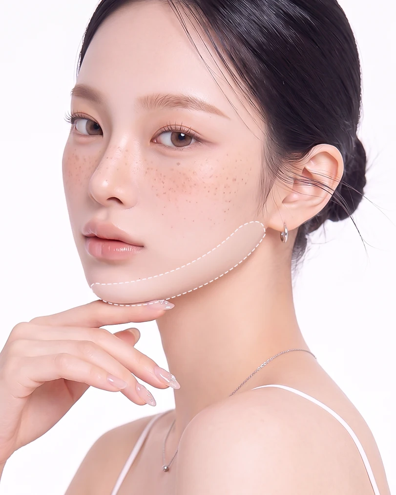 포인트 리프팅 시술 범위