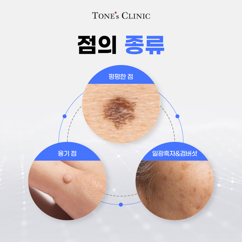 점제거/점빼기