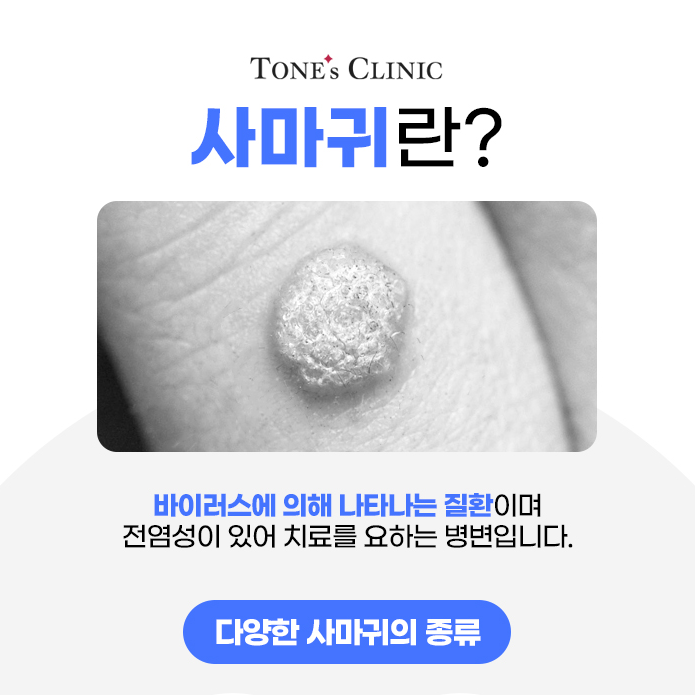 편평사마귀